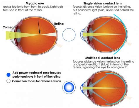 Beyond Vision Correction: The Future of Multiple Contact Lenses and Exciting Possibilities