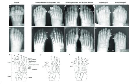 Exploring Cultural and Symbolic References to Toe Malformations