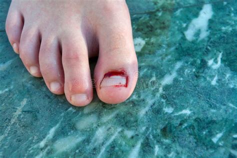 Medical Conditions That May Manifest as Dreams Involving Bleeding Nails