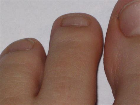 Unraveling the Enigma of Toenail Hemorrhage within Dreams