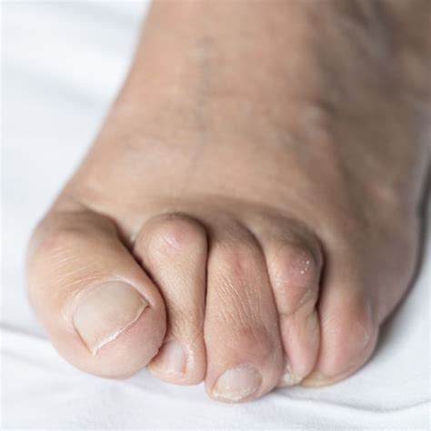 Unveiling the Psychological Significance of Toe Deformity Dream Encounters