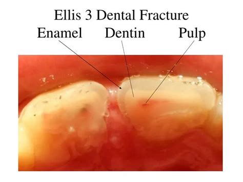  Decoding the Enigmatic Importance of Fractured Enamel in Visions 