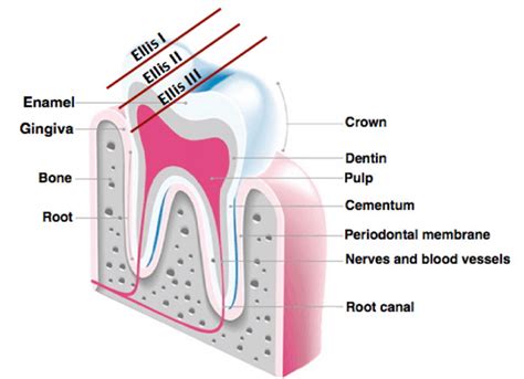  Decoding the Importance of Tooth Fracture in Subconscious Imagery 