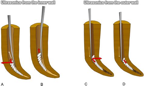  Discovering Meaning in Adversity: Decoding the Significance of a Fractured Instrument 