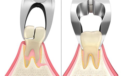  Emotional Release: The Role of Dental Extraction in Processing Traumatic Experiences 