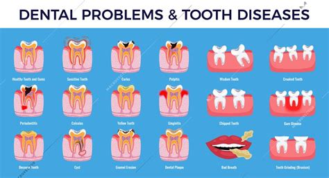  Exploring Different Types of Tooth Loss Dreams 