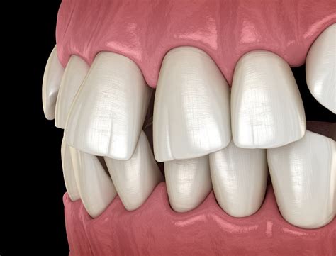  Exploring Practical Strategies to Unravel the Significance Associated with Misaligned Front Teeth in Dream Interpretation 