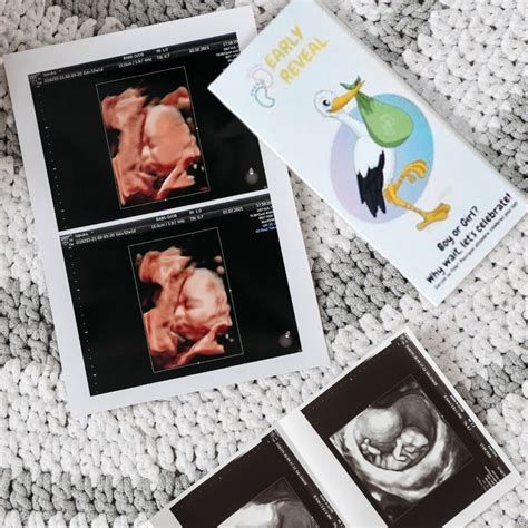  Gender Reveal: Discovering the Gender of Your Baby During the Sonogram 