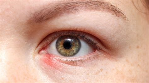  Preventing Recurrence: Tips to Help You Avoid Future Eye Stye Issues
