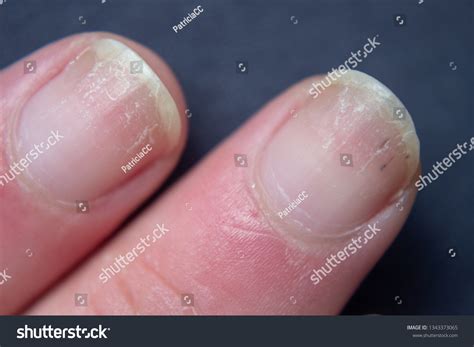  Symbolic Analysis of Damaged Fingernails 