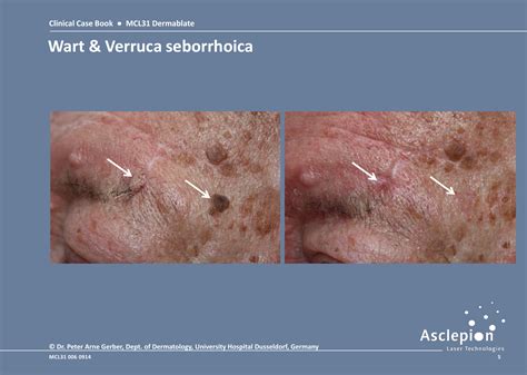  Techniques for Deciphering Visions of Afflictive Epidermal Lesions and Taking Appropriate Measures 