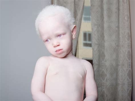  Unveiling the Hidden Meanings behind Dreams about an Infant with Albinism 