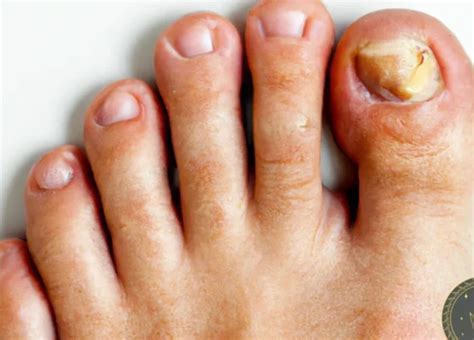  Unveiling the Significance Behind a Misplaced Toenail in Dreams 