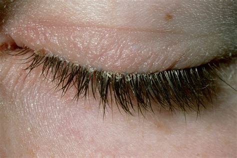  White Eyelashes: Indication of Well-being or Underlying Medical Condition? 