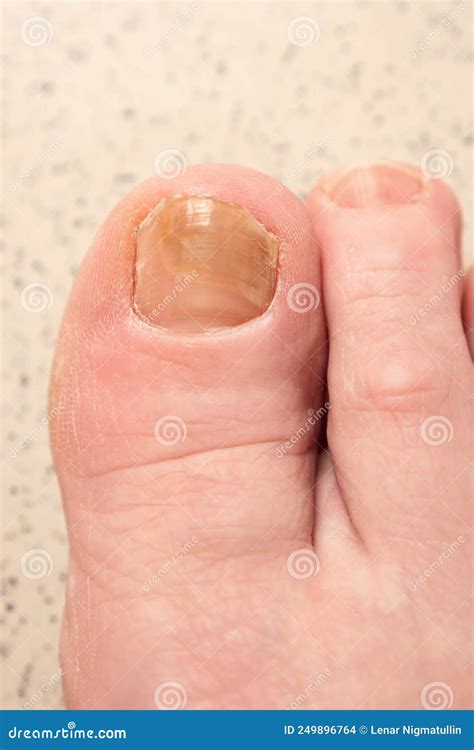 A Deeper examination of the Phenomenon: Understanding Dreams involving Injured Toenails