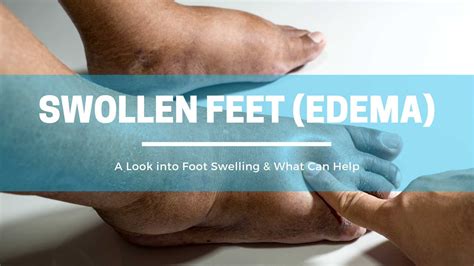 An Exploration of Edema and its Impact on Foot Health