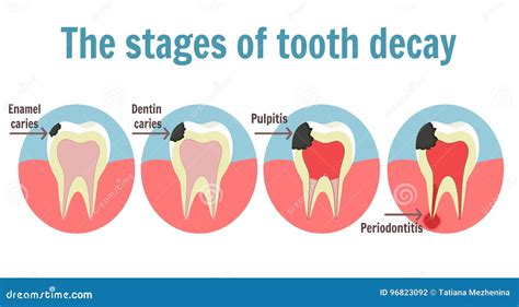 Analyzing Nightmares: Exploring the Dark Side of Dreams About Tooth Decay