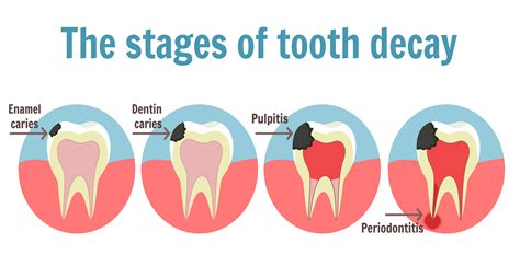 Analyzing Possible Causes of Decayed Tooth Nightmares