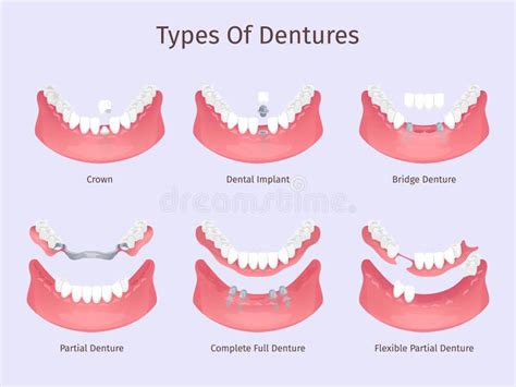 Analyzing the Emotional Context of Dreams About Dental Restorations