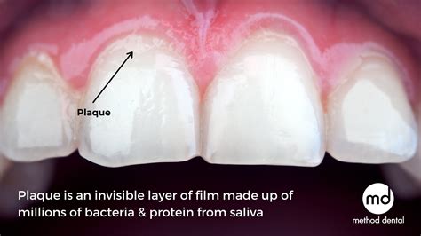 Analyzing the Meanings Behind Dreams Involving Sticky Residue Between Teeth