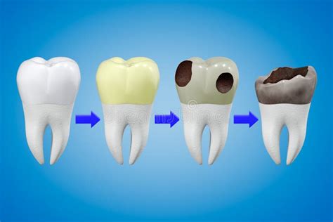 Analyzing the Possible Causes of Dreams Associated with Deteriorating Teeth Shedding