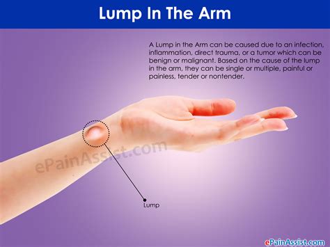 Analyzing the Potential Significance of Dreaming about a Lump on the Lower Extremity