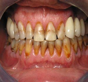 Analyzing the Role of Dental Health in Dreams Concerning Discolored Teeth