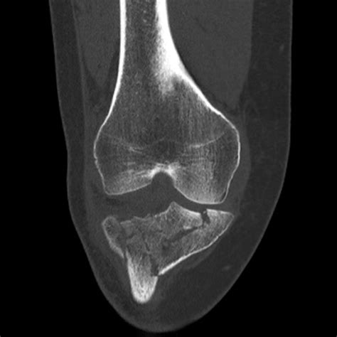 Analyzing the potential meanings behind dreaming of a fractured lower limb