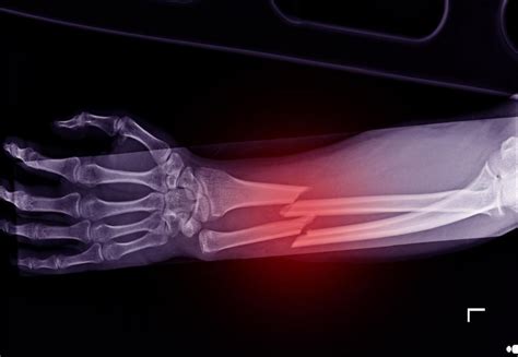 Breaking Bones: Decoding the Symbolism of an Arm Fracture