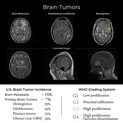 Can Dreams Foretell the Onset of Brain Tumors?