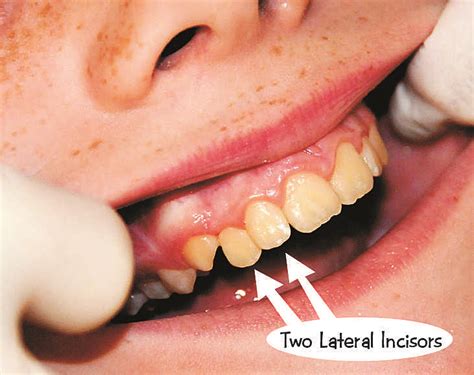 Causes and Factors Contributing to Supernumerary Teeth Formation