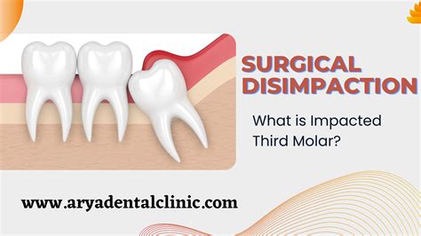 Challenges Associated with Extracting Third Molars