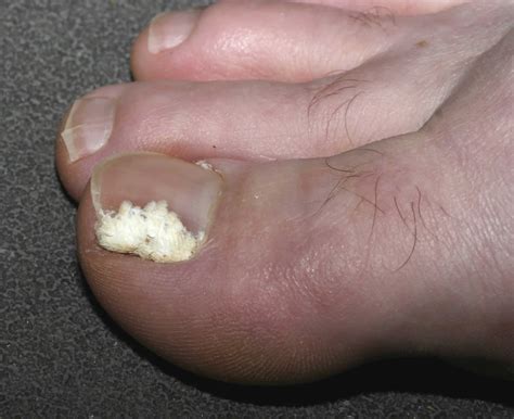 Common Causes for Infected Toes: From Bacterial Infections to Fungal Nail Disorders