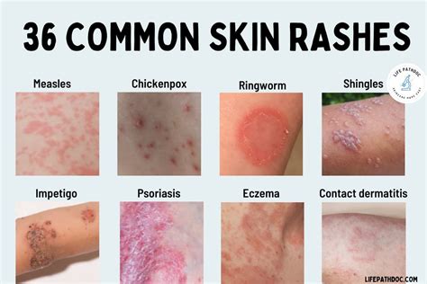 Common Causes of Leg Rash: Identifying and Treating