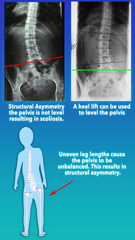 Common Physical Conditions that Result in Leg Asymmetry