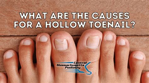 Common Reasons for the Loss of Toenails in Dreams