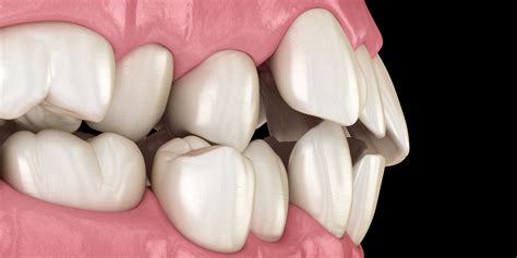 Common Scenarios and Variations of Dreams About Misaligned Teeth