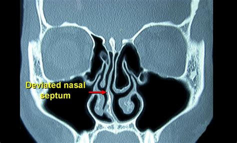 Common Triggers and Causes of Dreams Involving Slenders in Nasal Passages