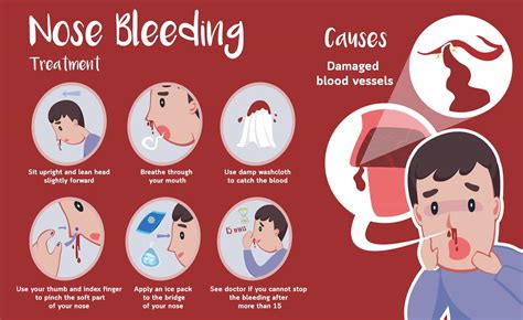 Common Triggers for Epistaxis: Could They Impact Symbolic Interpretation?