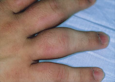 Common Triggers of Thumb Infections