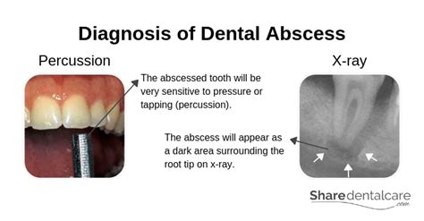 Complications and Risks: Understanding Potential Consequences of Neglected Oral Abscesses