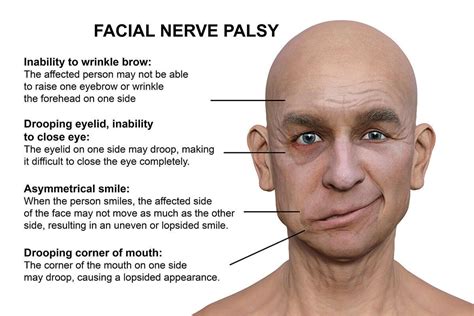 Coping Strategies: Navigating the Emotional Consequences of Facial Paralysis Nightmares