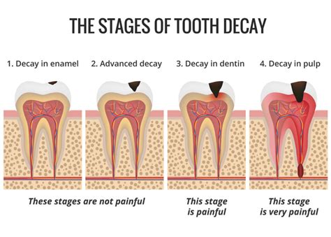 Coping Strategies for Dealing with Nightmares of Decaying Dental Structures