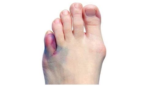 Coping Strategies for Managing Recurrent Envisions of Toenail Fracturing