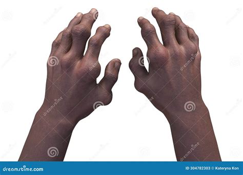 Cultural and Historical Influences on Symbolic Hand Deformity in Dreams