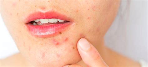 Dealing with Morning Acne: Effective Approaches