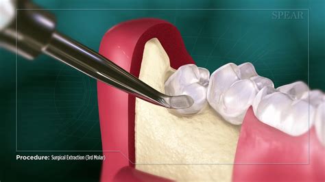 Deciding When to Remove Your Third Molars