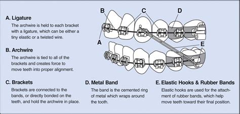 Deciphering the Meanings Behind Fractured Orthodontic Appliances: What Do They Represent?