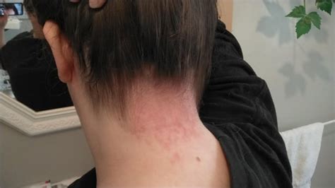 Deciphering the Significance of an Irritated Area on the Neck