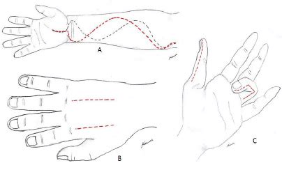 Decoding and Understanding Dreams Involving an Incision on the Forearm